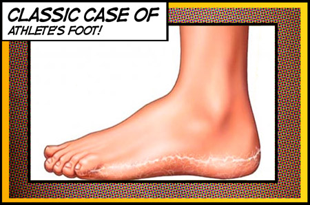 Athletes foot is similar to ringworm