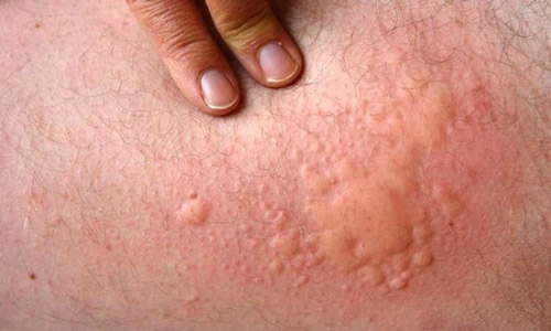 hives itchy skin relief medication suffering 