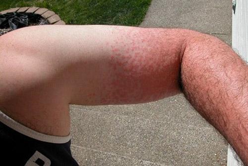 heat rash skin condition itchy itchiness relief