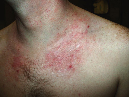Skin irritation: Common Related Symptoms and Medical ...