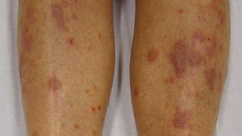 what does lichen planus look like? Skin itchiness and redness, sore itching relief