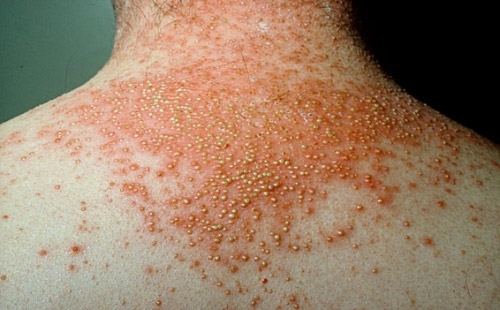 psoriasis is a skin condition similar to jock itch or tinea cruris