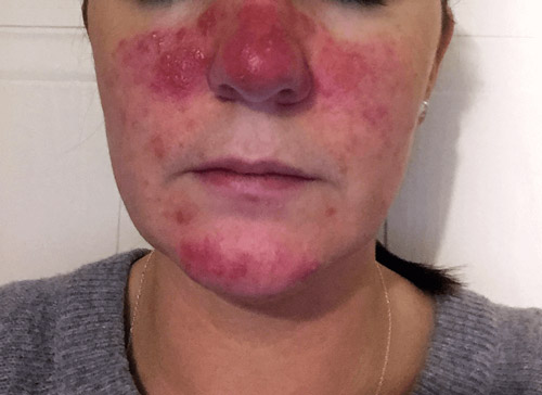 Rosacea is a skin condition similar to jock itch or tinea cruris