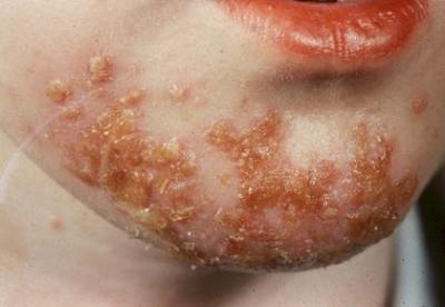 skin condition inpetigo causes itchiness and redness