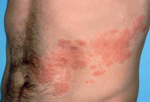 what does shingles look like? Shingles is a skin disease that causes itchiness and redness.